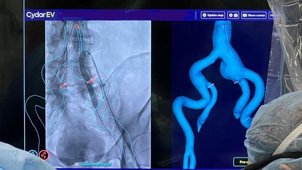 Two side-by-side images on a screen show an outline of tissue in a patient's body, and a 3D-rendering of that outline.