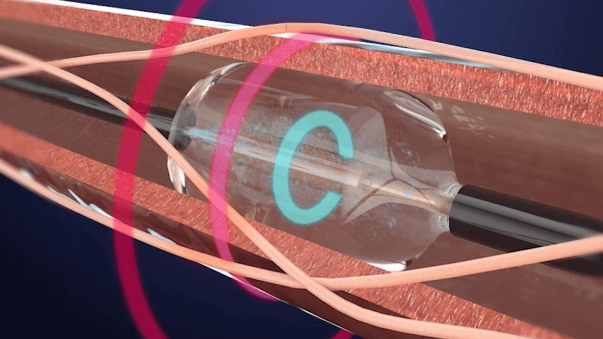 A rendering of Recor's Paradise renal denervation catheter within an artery.  The red circle indicates the heat generated from the ultrasound energy in the tissue delivering energy within the artery.